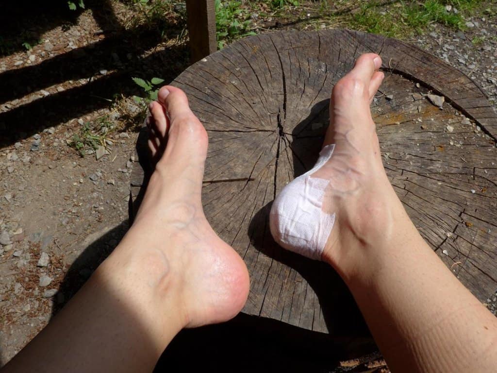 how to treat hiking blisters