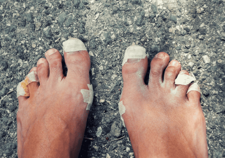 How to Prevent and Treat Blisters When Hiking or Backpacking
